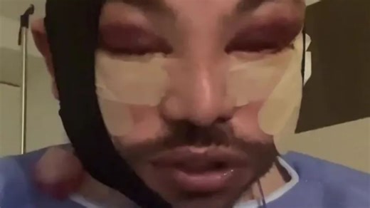 Towie star even more swollen and barely recognisable after more cosmetic surgery