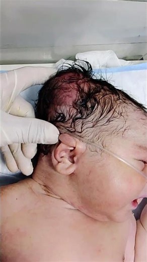 Good size baby with HIE admitted in NICU for close monitoring and supportive care