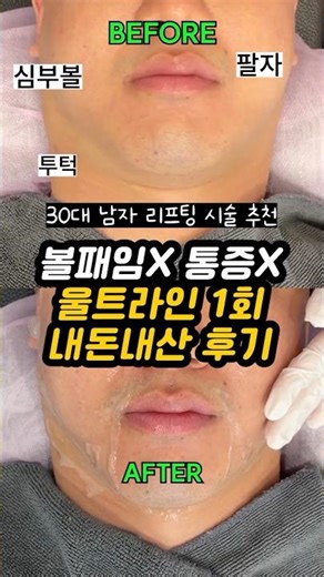 광고❌ 울트라인 리프팅 효과 좋은 ✅30대 남자 피부과 리프팅 추천✅