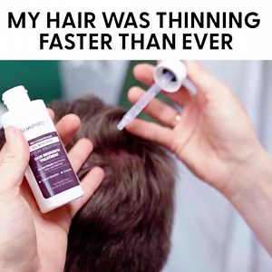 240 reactions · 30 shares | Our FDA-approved treatments are 90% effective at treating hair loss and are trusted by over 300,000 users.  Grow thicker, healthier hair  Combines FDA-approved Minoxidil and Finasteride to regrow hair  Save up to 50% on your first order  Free shipping Act now before it's too late! | Shapiro MD | Facebook