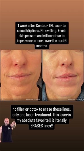 💉Botox Less Tightening #nofillers