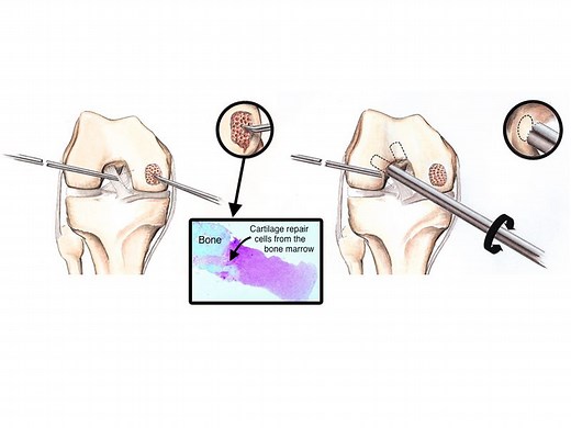 Why Microfracture Fails