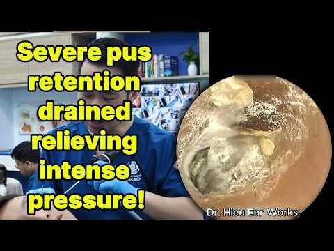 Severe pus retention drained relieving intense pre | ear cleaning | ASMR earwax | soothing |relax|