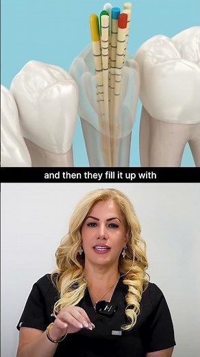 This is how a Root Canal works