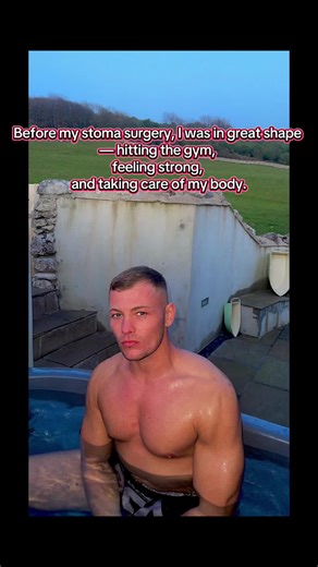 Overcoming Stoma Surgery: A Journey to Strength
