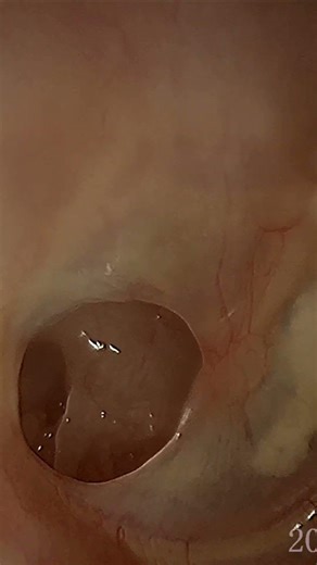 postero-inferior perforation exposing the round window niche. 🩺👂