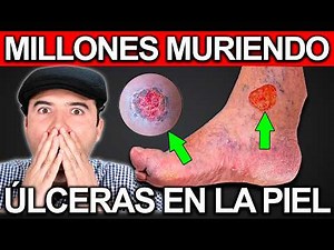 HOW TO HEAL SKIN ULCERS THAT WON'T GET BETTER | 5 Steps to Regenerate Varicose Ulcers