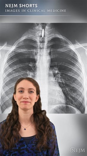 NEJM Editorial Fellow Julie R. Barzilay, M.D., presents an Images in Clinical Medicine case published on April 3, 2024. Read