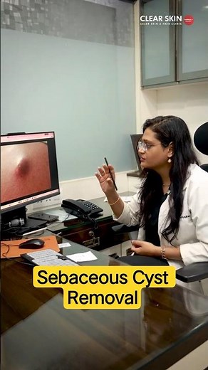 Sebaceous Cyst Removal: Why Medicines Do Not Work! | Clear Skin Clinic, Pune