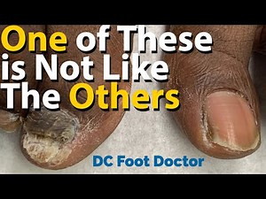 One Of These Is Not Like The Others: One-Sided Fungal Nail Infection, Callus Trimming
