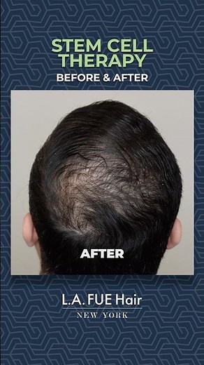 Hair Regrowth Before and After | Stem Cell Therapy