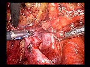 Prostate Cancer -Laparoscopic Extended Pelvic Nodes Excision • Video • MEDtube.net