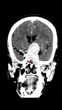 “An elderly lady went blind due to a giant pituitary tumor—we removed it through the Nose.” #brain