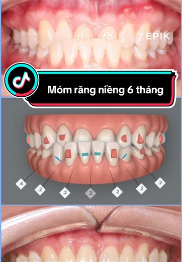 Móm răng điều trị nhanh và hiệu quả. Inbox Bs nhé #xuhuong #viral #fyp #niengrang #tiktok