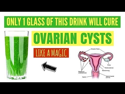 How to get rid of ovarian cysts naturally and fast without surgery – Home remedies for treatment