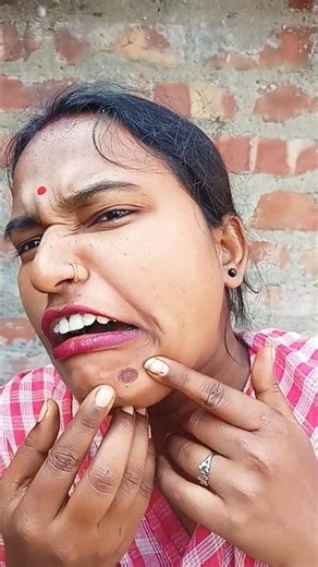 Pain + Comedy = This Reaction 😂 | Face Boil Pressing😉