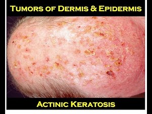 8h - Actinic Keratoses