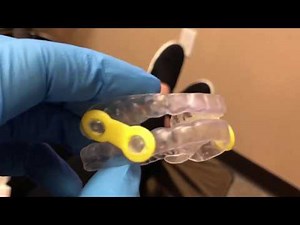 Sleep Apnea EMA Device