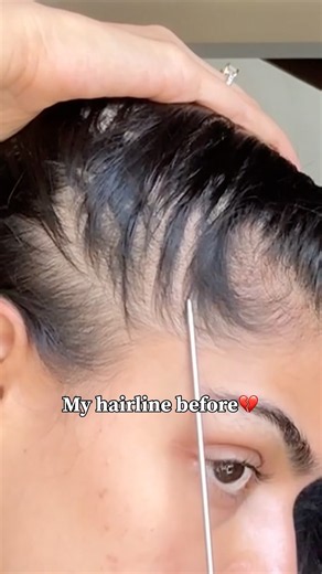 Can this serum actually grow my hair back?🧐#hairtransformation #viralproducts #hairgrowth #musthave