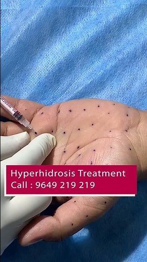 Best Hyperhidrosis Treatment for Palmar | Viral #shorts