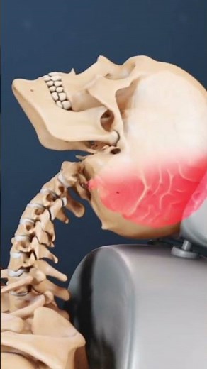The Effects of a Whiplash Injury on the Spine