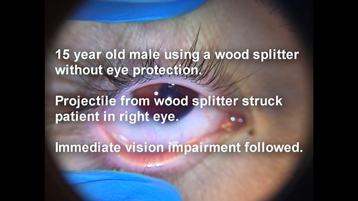 Hyphema Emergency - 眼科急诊|前房积血