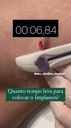 How long does it take to insert the Implanon?