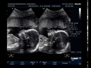 20 weeks 5 days Fetal Anomaly Scan Video - Part 2