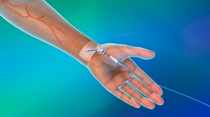 Y90 Radioembolization: Eye90 microspheres (TM) administration procedure