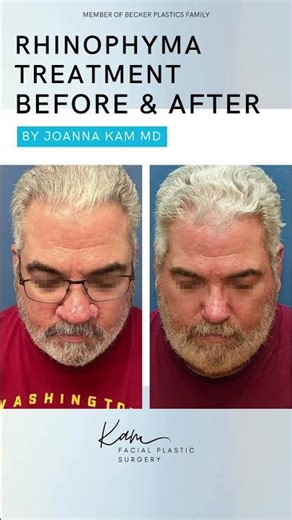 Rhinophyma Treatment: 4 Months Later 👃🌟 | Dr. Kam