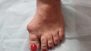 Take Care: Minimally invasive surgery can beat your bunion problem