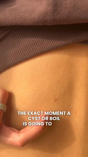 34 reactions | You know the exact moment a cyst or boil is going to...