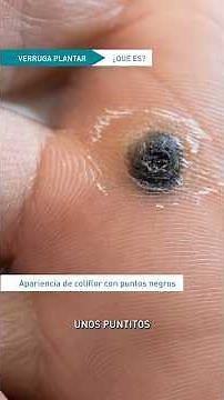 Verrugas plantares. Papilomas. Ojos de pescado. Podólogo Clínica del Pie Sevilla