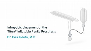 Infrapubic placement of Coloplast Titan® Inflatable Penile Prosthesis
