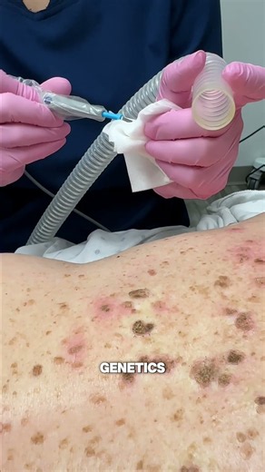 Treating Seborrheic Keratoses with Electrocautery | Bellevue Laser Cosmetic Center