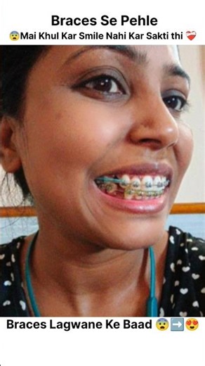 🔥😍Braces Transformation ll Braces + Confidence = Perfect Smile 🦷✨ #braces #ytshorts #shorts