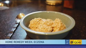 Home remedies for eczema