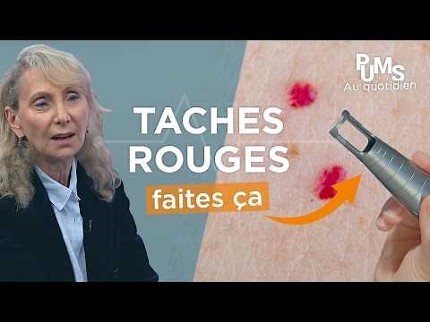 NE CONFONDEZ PAS ces rougeurs de la peau avec un CANCER (+ conseils pratiques pour s'en débarrasser)