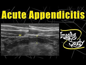 Acute Appendicitis || Ultrasound || Case 104