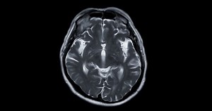 MRI Brain or Magnetic resonance imaging (MRI) of the brain in Axial t2 for dianosis stroke disease.