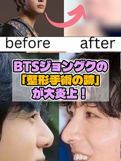 BTSジョングクの「整形手術の跡」が大炎上！#kpop #kpopfyp #fyp #abcxyz #jungkook #btsarmy