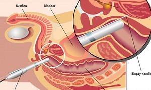 Biópsia de Próstata - Dr. Marcelo Thiel