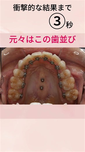 八重歯を抜歯 裏側矯正で改善 東京都世田谷区三軒茶屋の矯正歯科 #ワイヤー矯正 #前歯反対 #表側矯正 #Crowding #裏側矯正