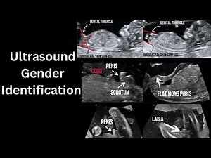 Ultrasound gender determination. How to identify? How accurate?