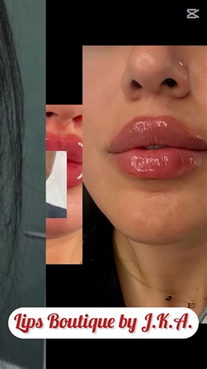 Lips Boutique® & Beauty Lab on Instagram: "No two lips are the same — and that’s the beauty of it. Every shape you see here was designed to enhance natural anatomy, balance, and individuality. This is custom lip artistry, not copy-paste lips. * * * * * #lipsboutiquebyjka CustomLips #NaturalEnhancement #LipDesign #FacialHarmony"