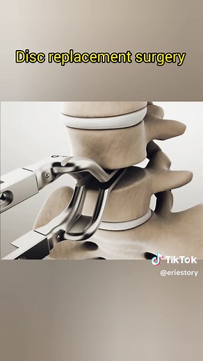 Understanding Disc Replacement Surgery Procedures