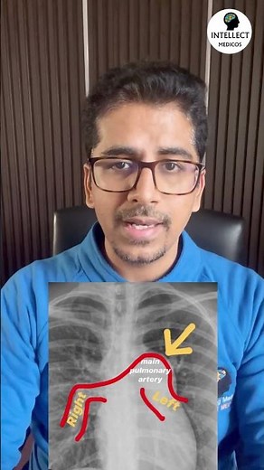 Guess the abnormalities in the Chest X-rays! #pulmonology #radiology #internalmedicine