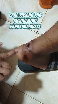 how to apply png mcionemore on abscess wounds caused by work shoes