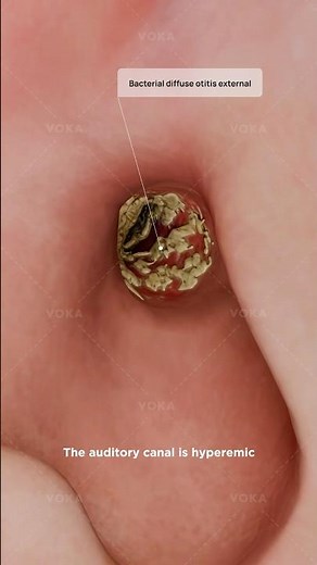 What is external otitis and how does it affect the external auditory canal? 3D visualization