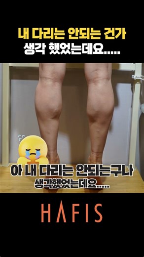 10년 전 종아리퇴축술 후 다시 생긴 알통… 초음파종아리성형술 결과는? #shorts